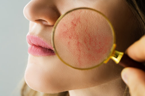 How to take rosacea under control?